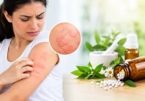 Best Homeopathic Medicine for Urticaria