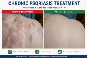 Chronic psoriasis treatment before and after