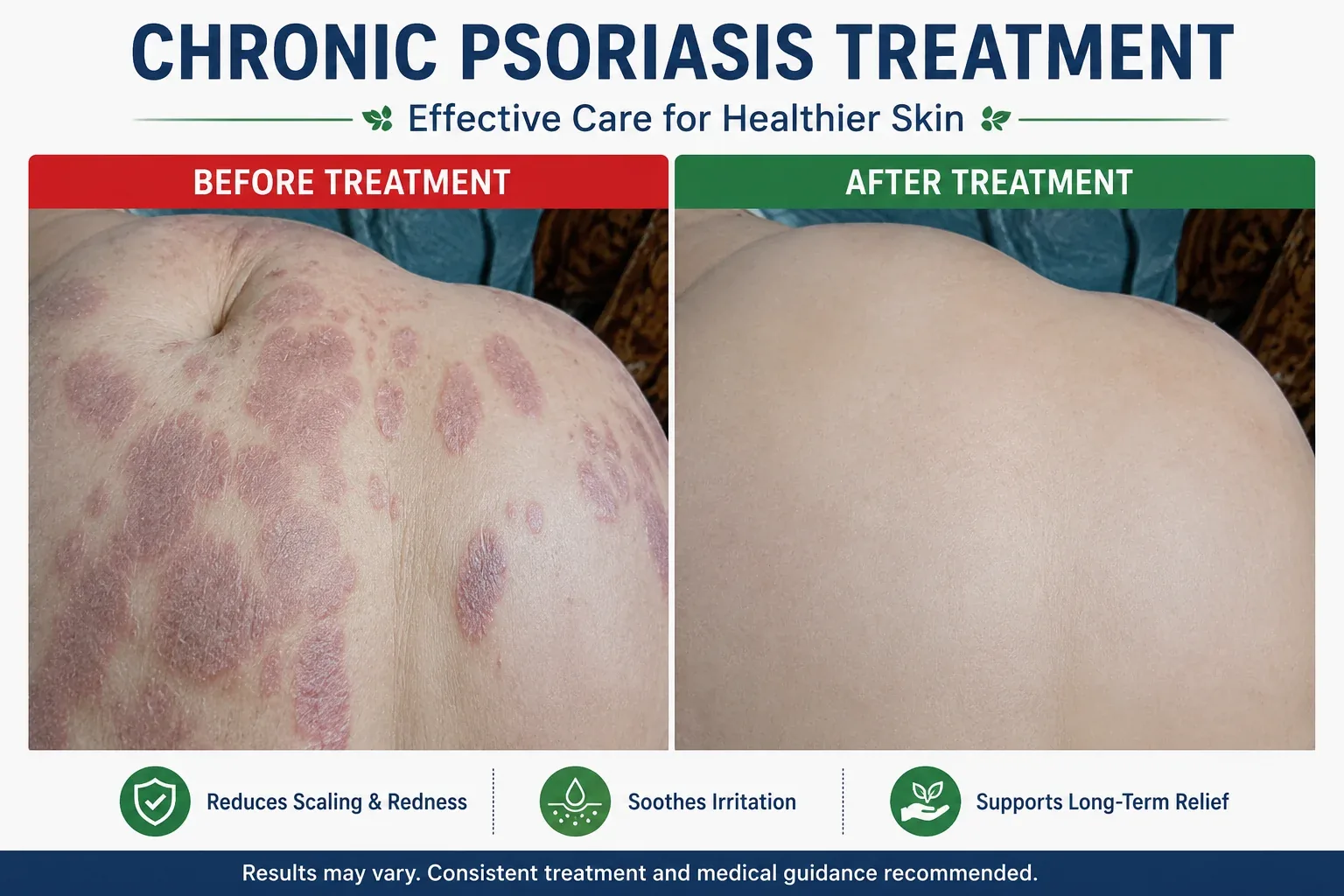 25 Years of Chronic Psoriasis – A Successful Journey to Complete Recovery
