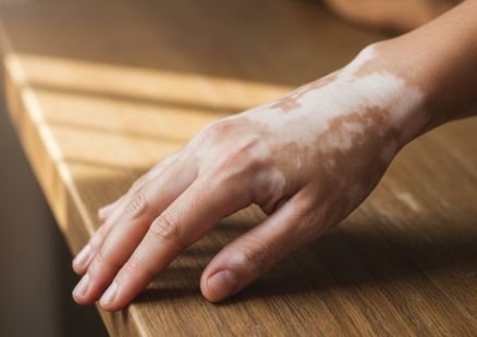 Vitiligo Treatment