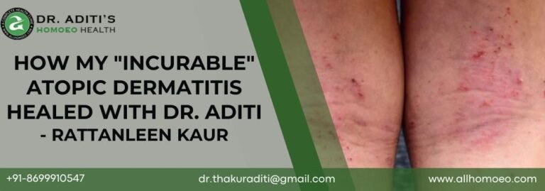 How My Incurable Atopic Dermatitis Healed With Dr. Aditi - RATTANLEEN KAUR