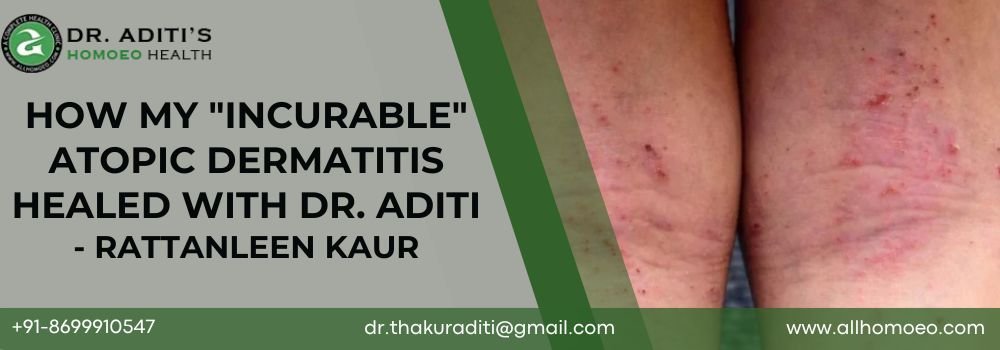How My Incurable Atopic Dermatitis Healed With Dr. Aditi - RATTANLEEN KAUR How My Incurable Atopic Dermatitis Healed With Dr. Aditi - RATTANLEEN KAUR