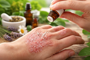 Homeopathy Treatment for Psoriasis