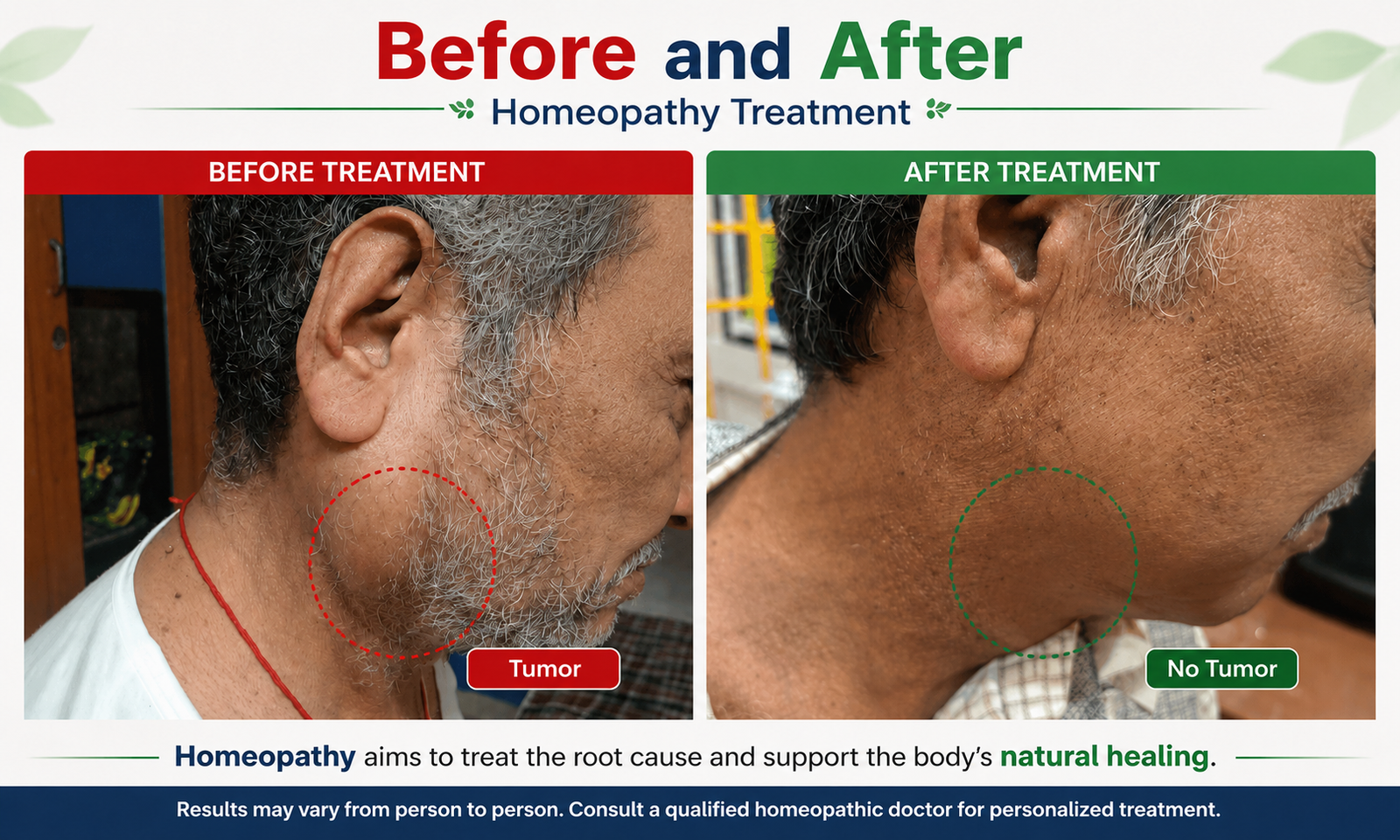 Before and after homeopathy treatment
