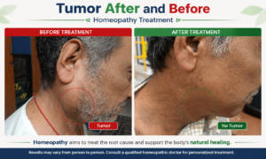Tumor before and after homeopathy treatment