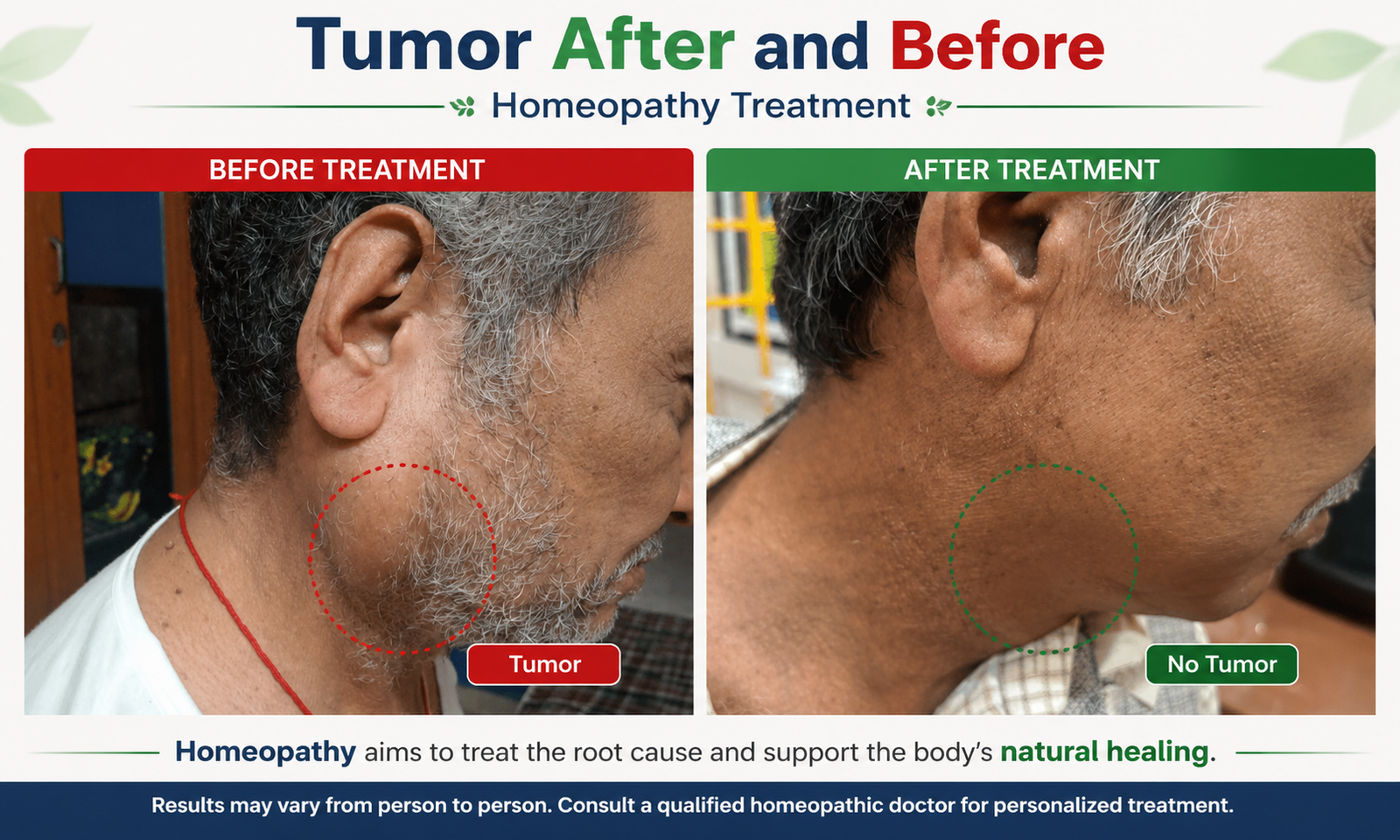Tumor before and after homeopathy treatment